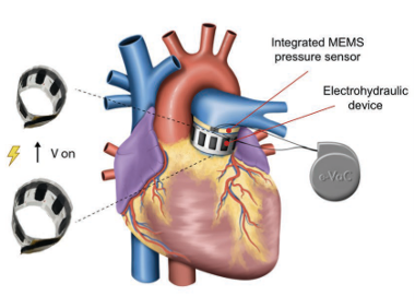 Extra vascular actuator